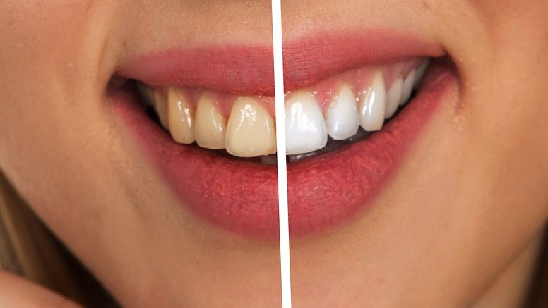 Cum să scapi de tartru și să îți albești dinții în doar 4 minute!