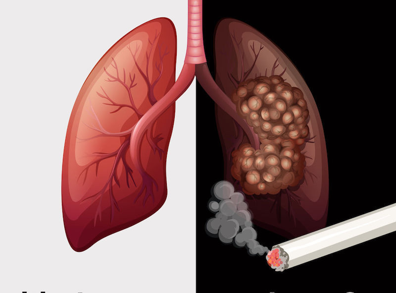Curățați-vă plămânii de toxine, scoateți nicotina și gudronul din organism