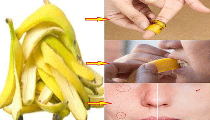 Coaja de banana remediu extern pentru cosuri si alte 5 intrebuintari despre care cu siguranta nu stiati