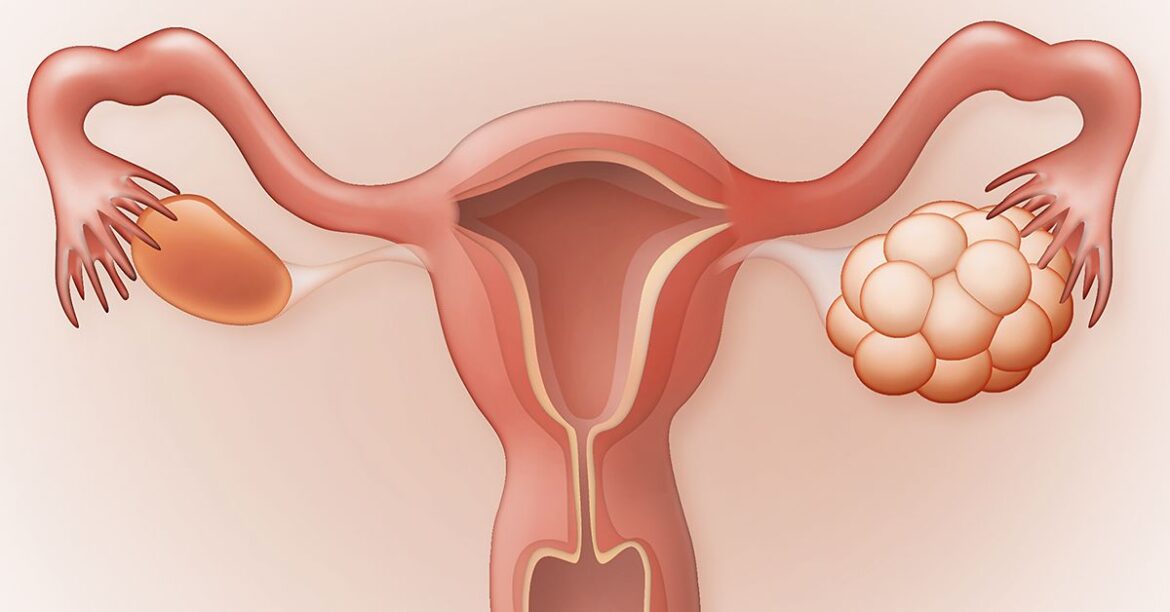 Cele mai bune remedii pentru sindromul ovarelor polichistice – dr. Jin Sung