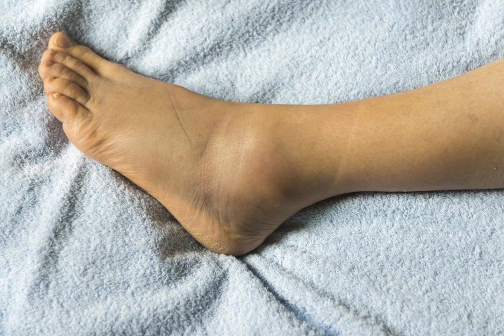 Ce spun picioarele despre sănătatea ficatului –  9 indicii 