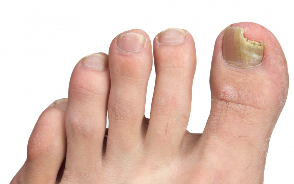 Infecția unghiei de la picioare (onicomicoza) – cauze, simptome și tratament naturist