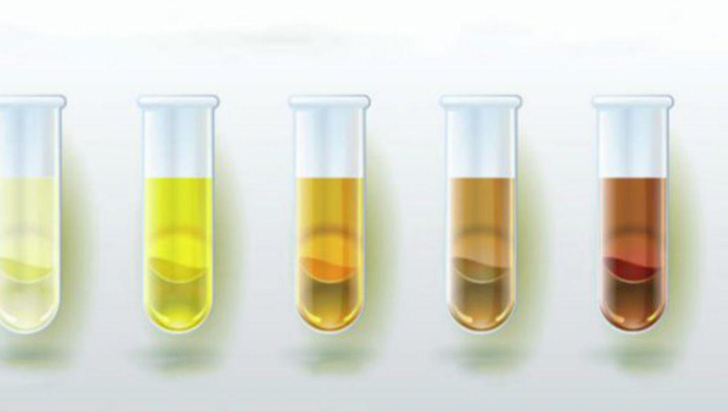Cum se cunoaște starea de sănătate după culoarea urinei