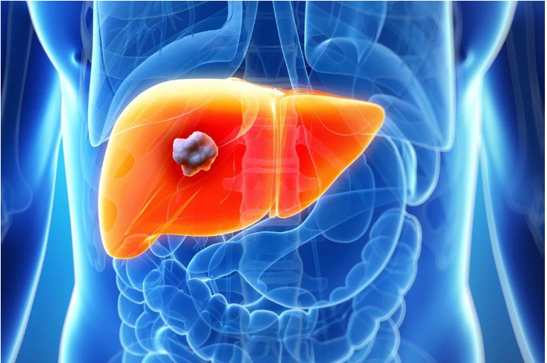 Chist hepatic – simptome și principalul lucru pe care trebuie să-l știți