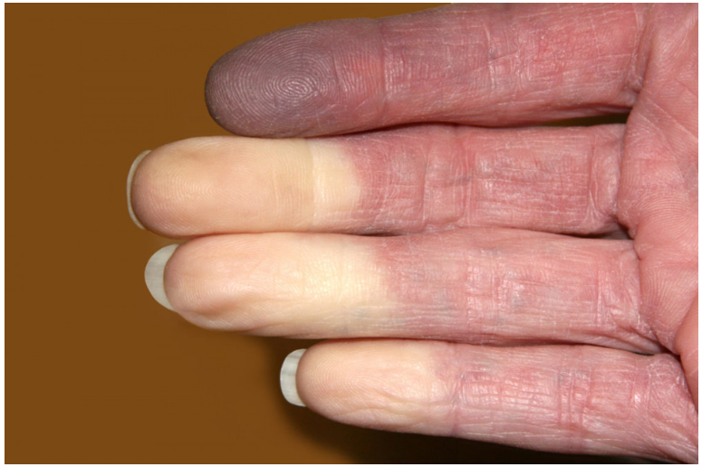 Fenomenul lui Raynaud: Când degetele de la mâini și de la picioare reci nu sunt doar o circulație slabă a sângelui